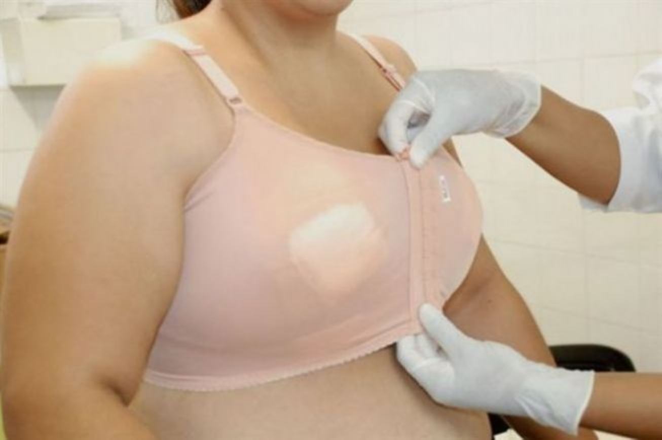 Hospital da Mulher realiza avaliação econômica e social de candidatas a cirurgia de redução de mamas