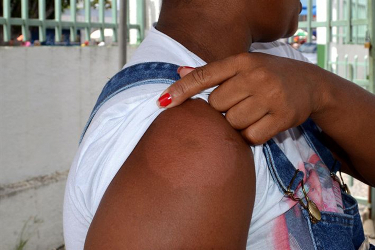 Janeiro Roxo: Hanseníase pode causar manchas e perda de sensibilidade