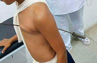 IMPRESSIONANTE: Menino sobrevive a espeto atravessado no coração