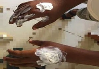 Teixeira de Freitas: Mãe queima as mãos do filho de 8 anos por ele ter gasto R$ 5 reais sem autorização